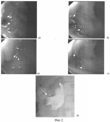 Способ диагностики язвенно-деструктивных осложнений при язвенной болезни двенадцатиперстной кишки (патент 2321425)