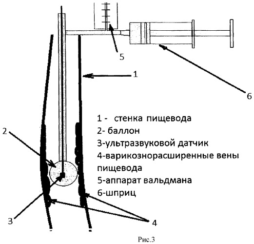 Способ измерения кровяного давления в венах пищевода (патент 2456913)