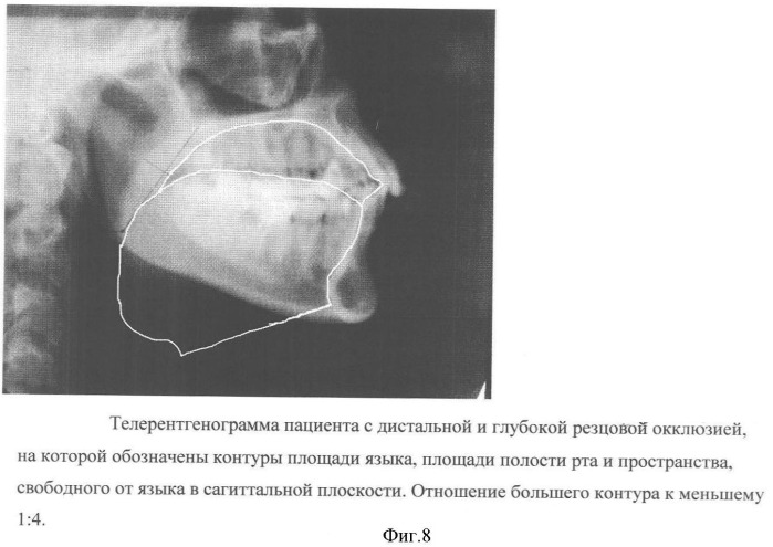 Способ диагностики аномалий зубочелюстной системы (патент 2360604)