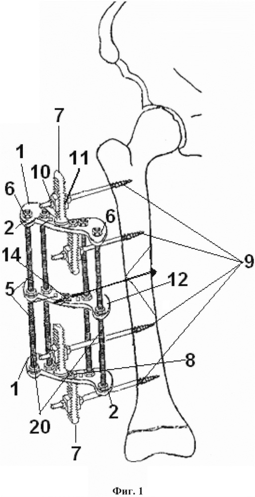 Аппарат для лечения оскольчатых переломов бедренной кости у детей (патент 2629050)