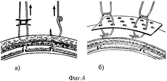 Устройство для фиксации реберной панели (патент 2430699)