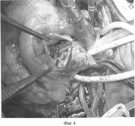Способ билатеральной аортоаннулопластики при узком фиброзном кольце аорты (патент 2300321)