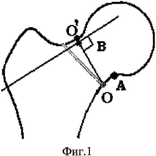 Способ остеосинтеза переломов шейки бедра (патент 2350293)
