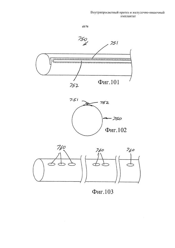 Внутрипросветный протез и желудочно-кишечный имплантат (патент 2626885)