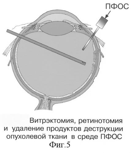 Способ электрохимической деструкции, хирургического удаления и фотодинамической профилактики рецидивов внутриглазных новообразований в среде перфторорганического соединения (варианты) (патент 2244533)