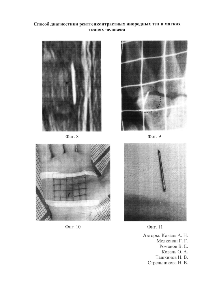 Способ диагностики рентгенконтрастных инородных тел в мягких тканях человека (патент 2605148)