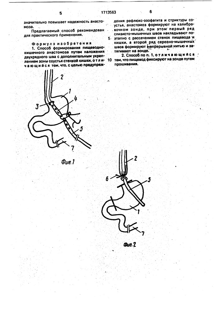 Способ формирования пищеводно-кишечного анастомоза (патент 1713563)