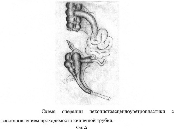 Способ цекоцистоасцендоуретропластики при экстрофии клоаки (патент 2400154)