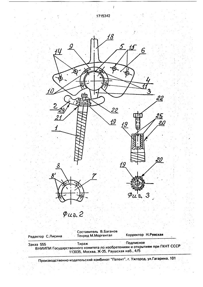 Эндопротез лучезапястного сустава (патент 1715342)