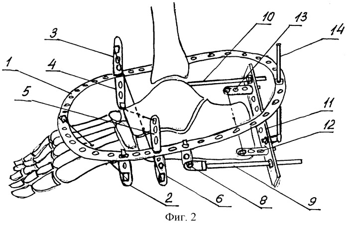 Аппарат для лечения смещенных переломов пяточной кости (патент 2285487)