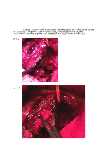 Способ малоинвазивной циркулярной декомпрессии спинномозгового канала при осложненных взрывных переломах нижнегрудного и поясничного отделов позвоночника из модифицированного межмышечного параспинального доступа (патент 2592779)