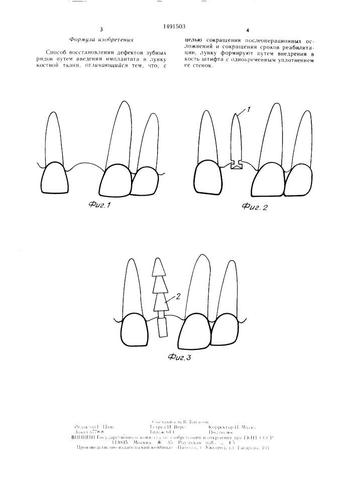 Способ восстановления дефектов зубных рядов (патент 1491503)