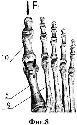 Способ хирургического артропластического лечения вальгусной деформации первого пальца стопы (патент 2563064)