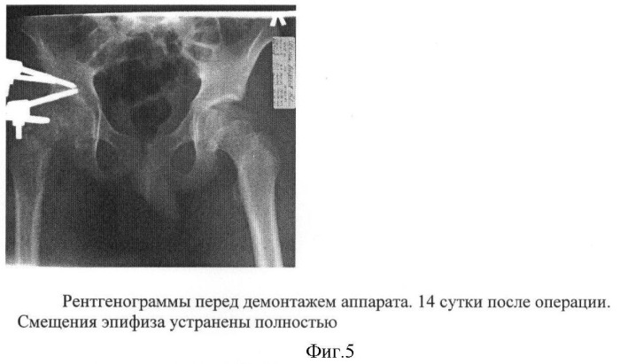 Способ лечения юношеского эпифизиолиза головки бедренной кости у детей (патент 2422110)