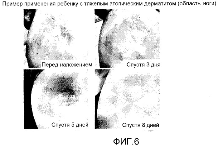 Повязка для лечения кожных заболеваний и облегчения симптомов кожных болезней, вызывающих экссудацию белков крови (патент 2524628)