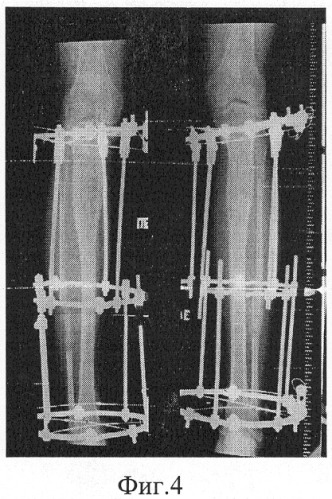 Способ удлинения трубчатой кости (патент 2271766)