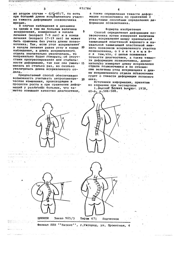 Пособ определения деформации позвоночника (патент 651784)