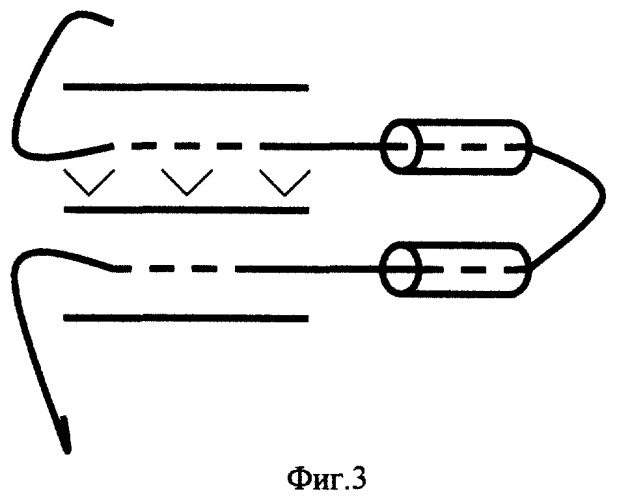 Способ создания отсроченного компрессионного межкишечного анастомоза (патент 2290099)
