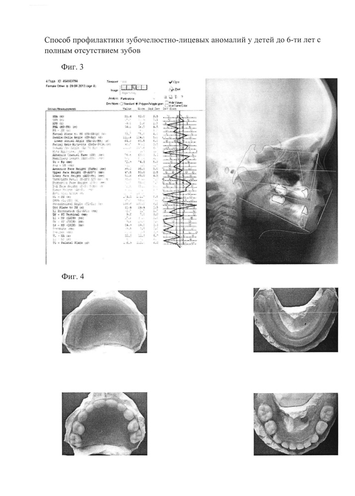 Способ профилактики зубочелюстно-лицевых аномалий у детей до 6 лет с полным отсутствием зубов (патент 2663631)