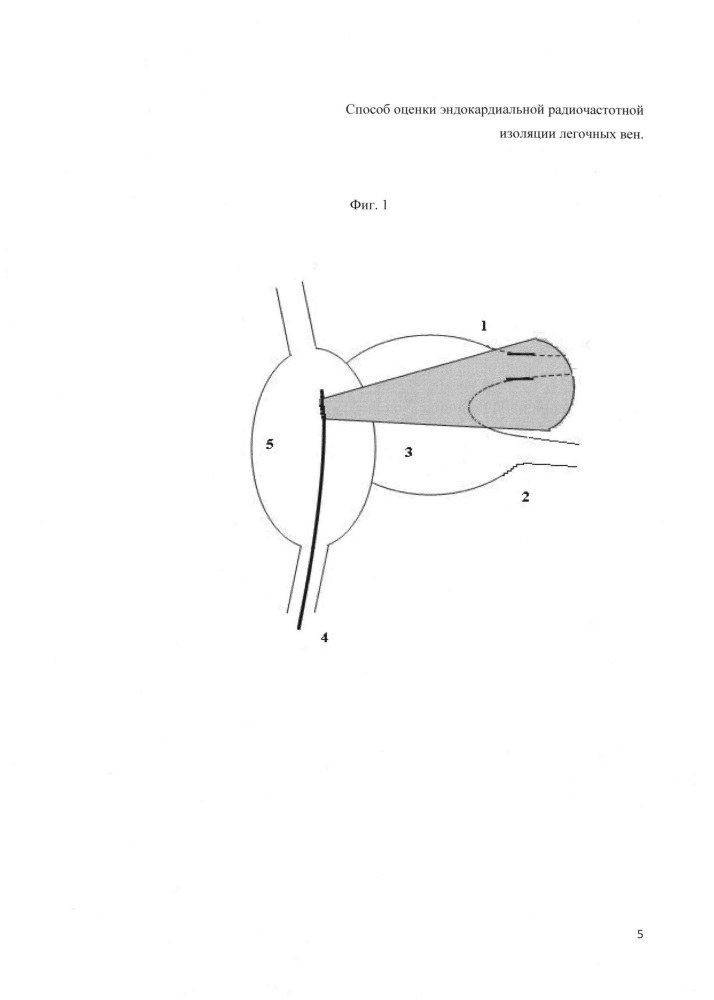 Способ оценки эндокардиальной радиочастотной изоляции легочных вен (патент 2645413)