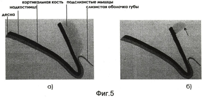 Способ туннельной остеопластики альвеолярного гребня во фронтальном отделе верхней челюсти (патент 2445939)