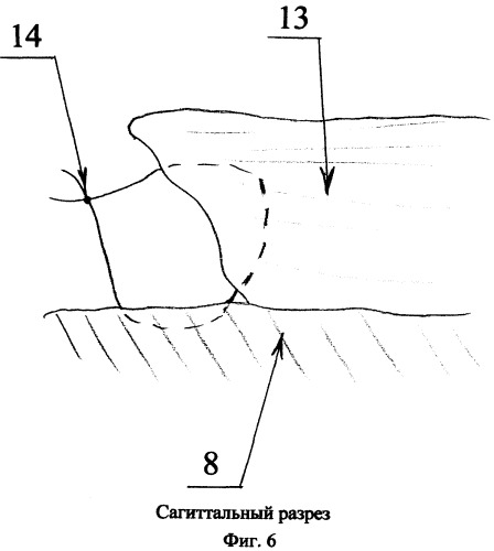 Способ миопластики после радикальных органосохраняющих операций на молочной железе (патент 2436521)