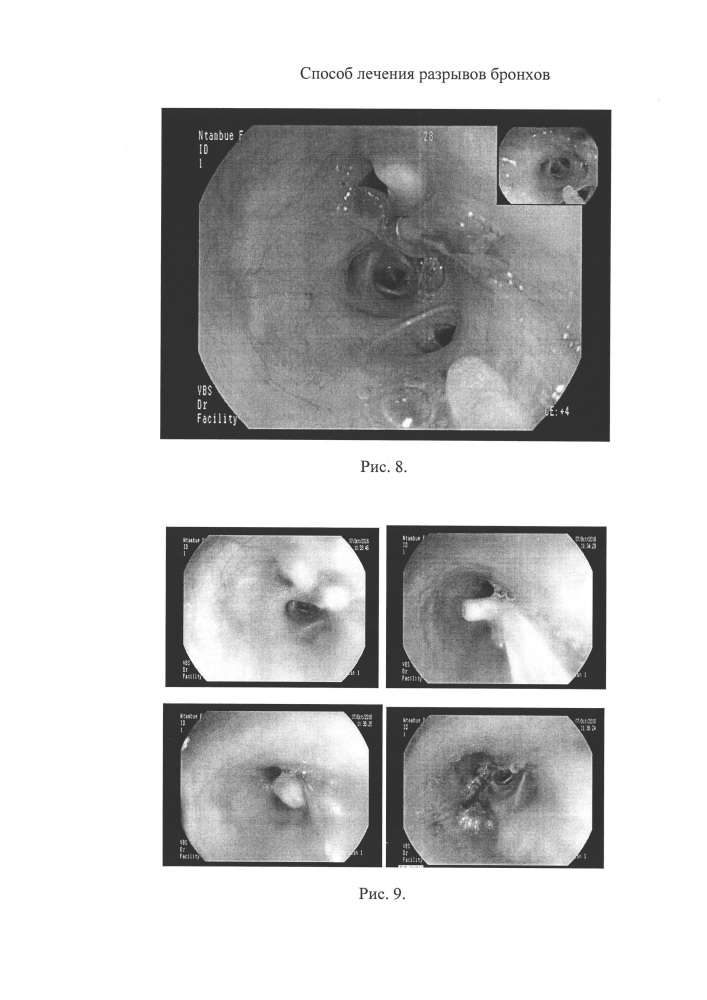 Способ лечения разрывов крупных бронхов (патент 2651691)