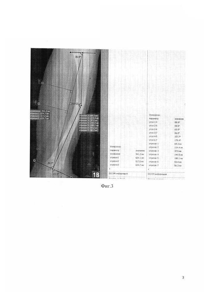 Способ оценки степени деформаций диафиза трубчатой кости и определения величины и уровня коррекции деформации для ее хирургического исправления (патент 2600070)