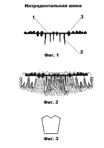 Интрадентальная шина из диоксида циркония (патент 2583146)