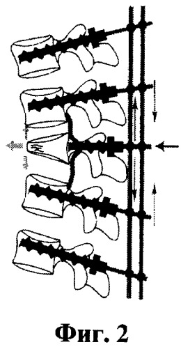 Способ вертебропластики при переломах тел позвонков (патент 2462206)