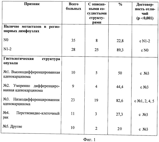 Способ прогнозирования риска лимфогенного метастазирования при раке желудка (патент 2425639)