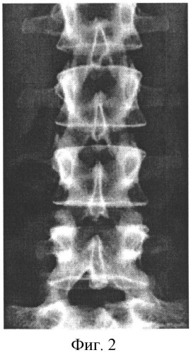 Способ прицельной рентгенографии пояснично-крестцового отдела позвоночника с функциональной нагрузкой (патент 2536557)