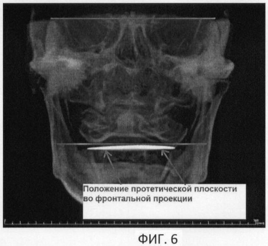 Способ определения расположения протетической верхней плоскости у пациентов с нарушениями целостности зубных рядов (патент 2470587)