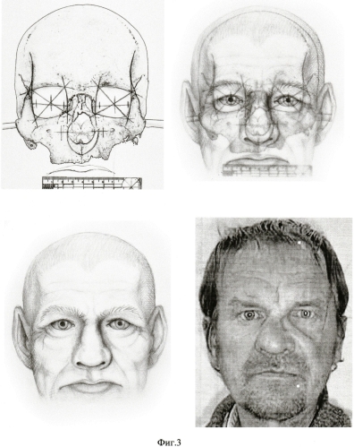 Способ определения центра радужной оболочки глаза при графической реконструкции лица по черепу (патент 2572303)