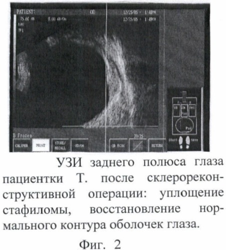Способ склерореконструктивного лечения высокой близорукости (патент 2367394)