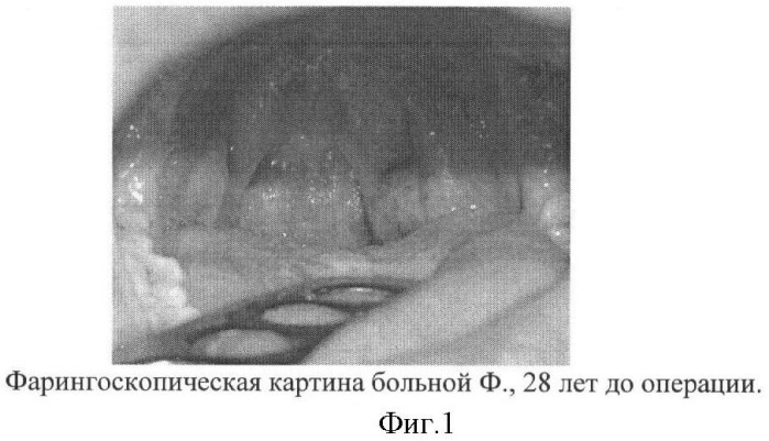 Способ лазерной двусторонней тонзиллэктомии (патент 2364369)