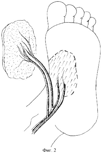 Способ реконструкции мягкотканых дефектов опорной поверхности стопы (патент 2343863)