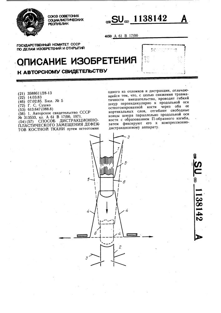 Способ дистракционно-пластического замещения дефектов костной ткани (патент 1138142)