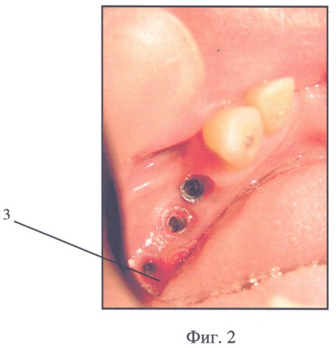 Устройство для формирования десневого канала зубного протеза (патент 2318467)
