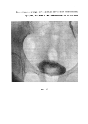 Способ эндоваскулярной эмболизации внутренних подвздошных артерий у пациенток с новообразованиями малого таза (патент 2576092)
