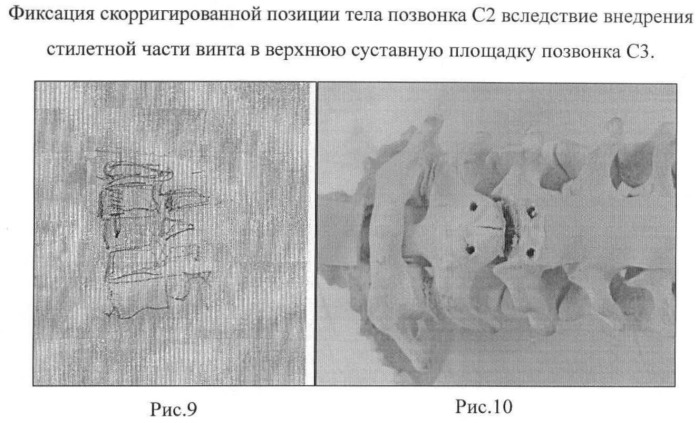 Способ анкерной коррекции и фиксации травматических дислокаций тела позвонка с2 при переломах палача (патент 2463978)