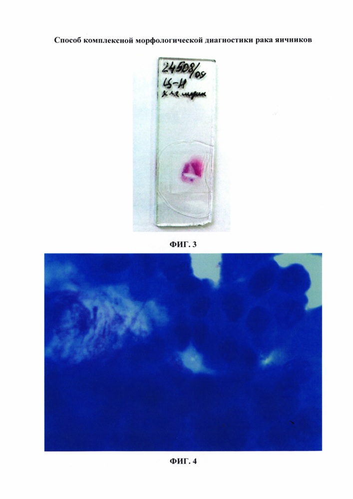 Способ комплексной морфологической диагностики рака яичников (патент 2640189)