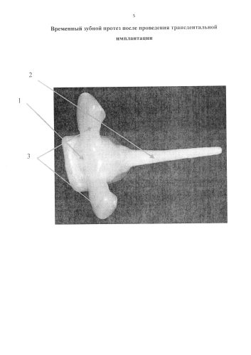 Временный зубной протез-прототип после проведения трансдентальной имплантации (патент 2584556)