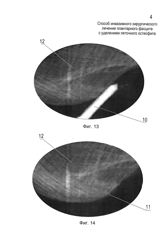 Способ инвазивного хирургического лечения плантарного фасцита с удалением пяточного остеофита (патент 2619580)