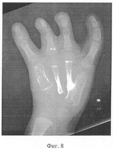 Способ реконструкции пальцев при врожденной патологии кисти (патент 2307612)