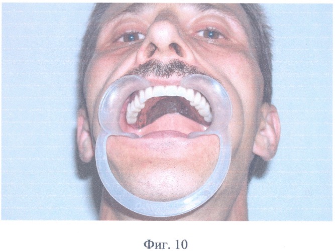 Полный съемный зубной протез верхней челюсти (патент 2314773)