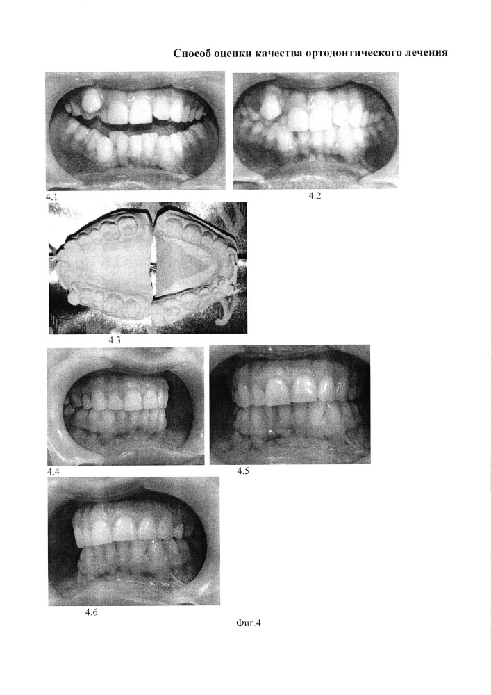 Способ оценки качества ортодонтического лечения (патент 2616761)