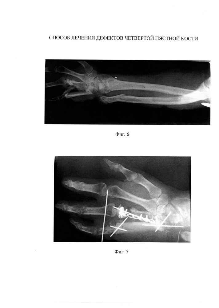 Способ лечения дефектов четвертой пястной кости (патент 2610534)