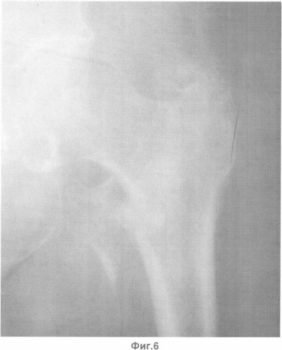 Способ лечения нестабильных оскольчатых внесуставных переломов проксимального отдела бедренной кости (патент 2361535)