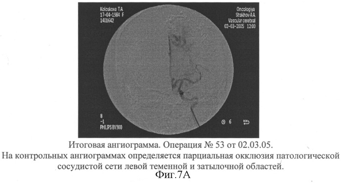 Способ эмболизации артериовенозных мальформаций головного мозга в условиях общей анестезии и управляемой гипотонии (патент 2315634)